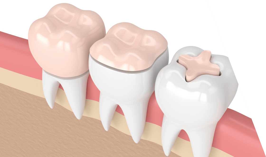 traitement inlay onlay Drs Dard Cannet chirurgiens dentistes Olivet