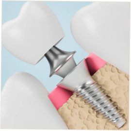 Drs Dard Cannet soin implant dentaire