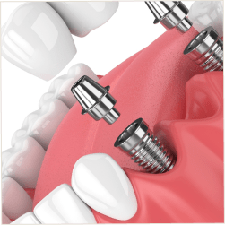 Drs Dard et Cannet traitement bridge sur implants